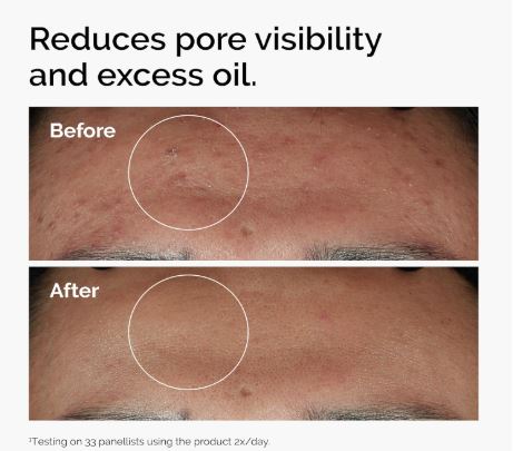 The Ordinary Niacinamide 10% + Zinc 1%, Smoothing Serum for Blemish-Prone Skin My Store